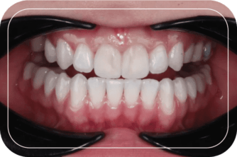 Пациент №3. Реставрация двух передних зубов винирами