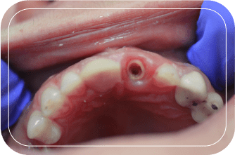 Пациент №2. Удаление зуба с одномоментной имплантацией