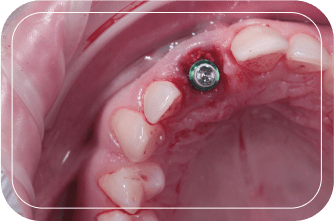 Пациент №2. Удаление зуба с одномоментной имплантацией