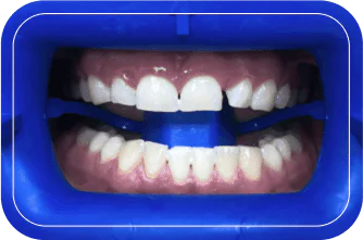 Пациент №1. Отбеливание Zoom 4