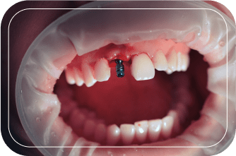 Пациент №1. Удаление зуба с одномоментной имплантацией