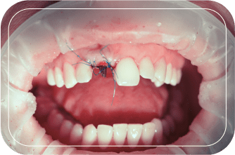 Пациент №1. Удаление зуба с одномоментной имплантацией