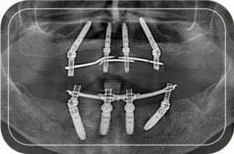 Пациент №1. Протезирование верхней и нижней челюстей  на 4 имплантах по протоколу All-on-4