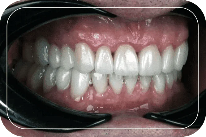 Пациент №5. Тотальная реабилитация цельнокерамическими реставрациями