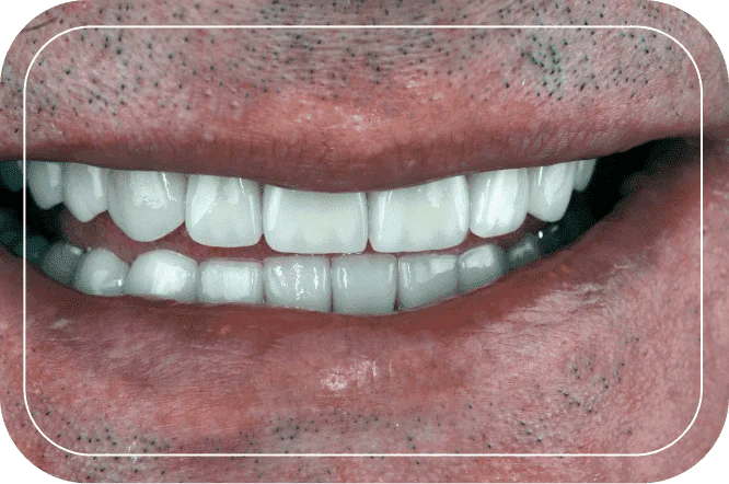 Пациент №5. Тотальная реабилитация цельнокерамическими реставрациями