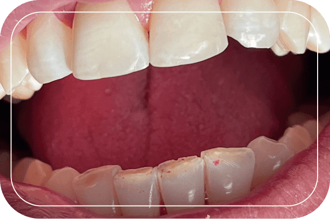Пациент №6. Реставрация верхних передних зубов композитными винирами
