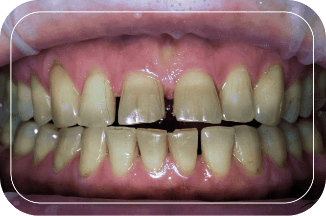 Пациент №4. Реставрация верхних передних зубов керамическими винирами