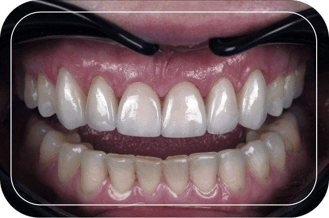 Пациент №4. Реставрация верхних передних зубов керамическими винирами